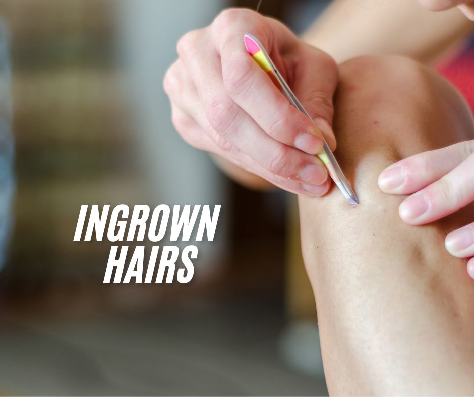 Smooth Skin: How To Stop Ingrown Hair For Good