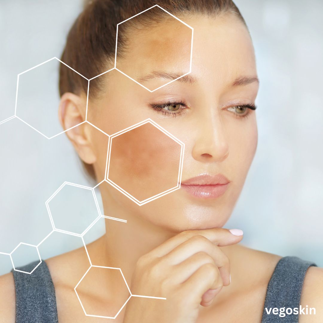 How To Prevent Melasma While Pregnant: Tips That Actually Work