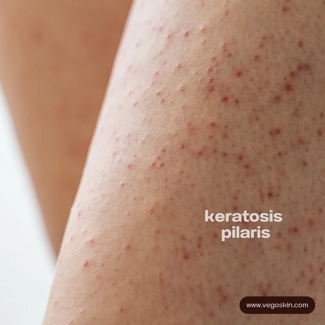The Truth About Keratosis Pilaris And Why It’s So Common